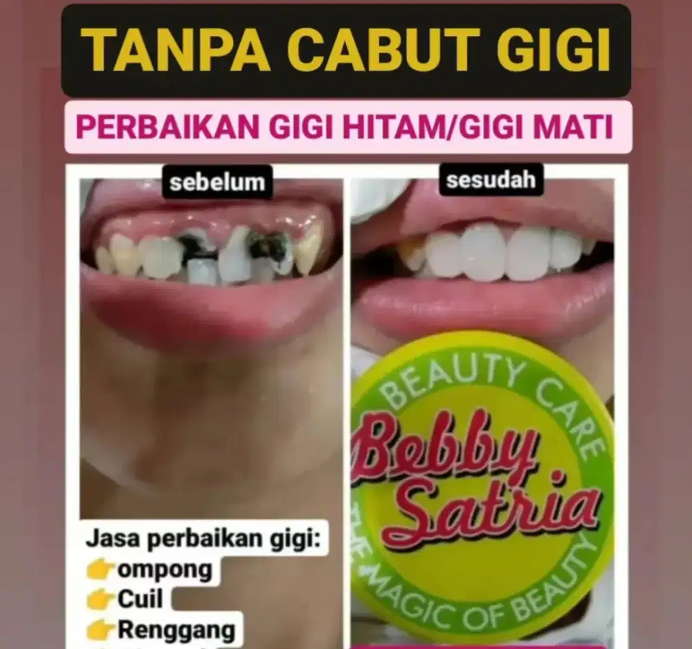 Pasang gigi laser permanen